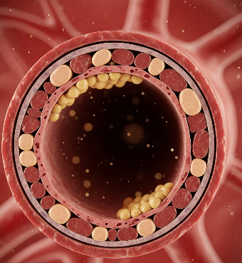 LDL 콜레스테롤 이란?