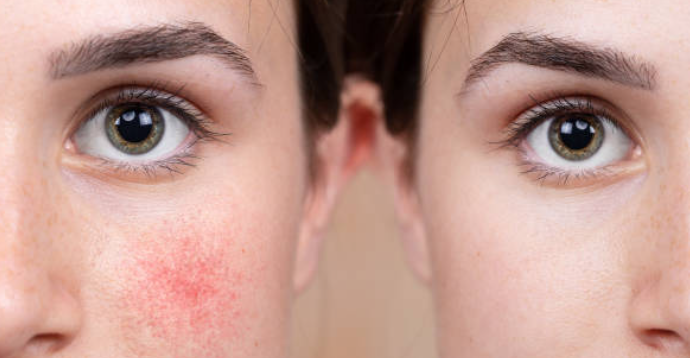 수란트라 크림 성분