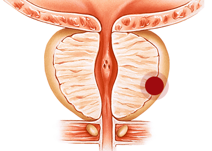전립선이 커져 요도를 압박하고 있는 단면 구조