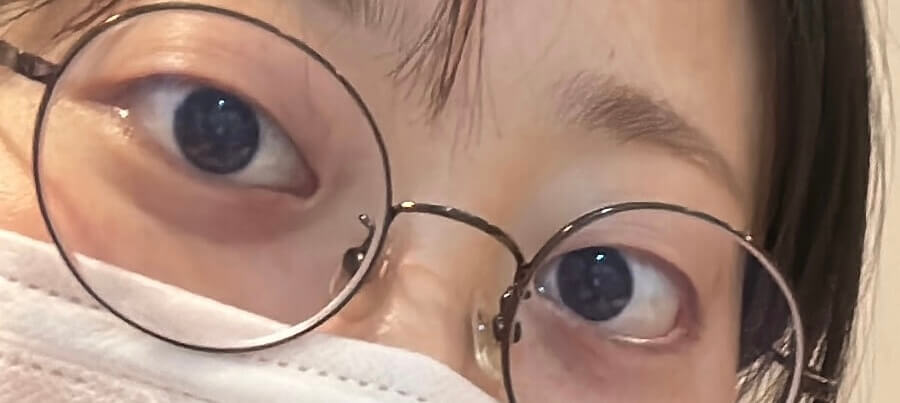 갑상선안병증, 안구돌출