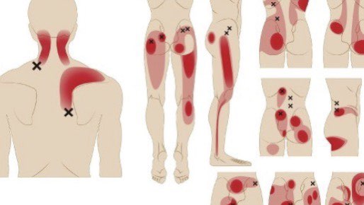 근막통증 증후군에 대한 사진