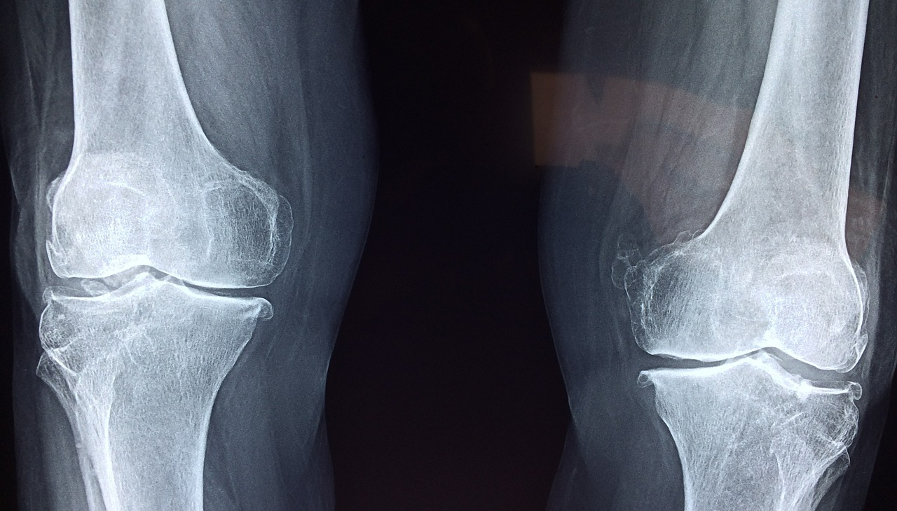 골다공증 관련 사진