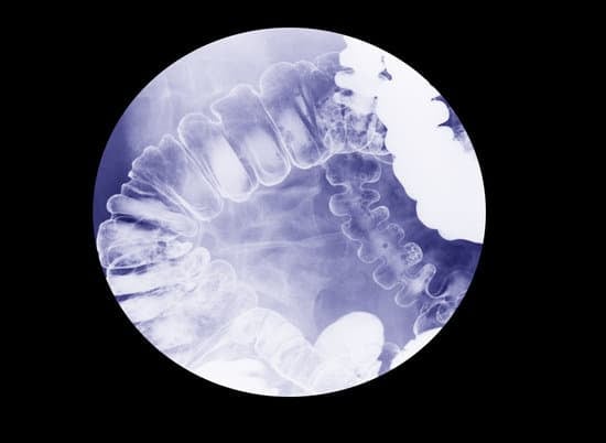 대장 조영술 (Barium Enema)