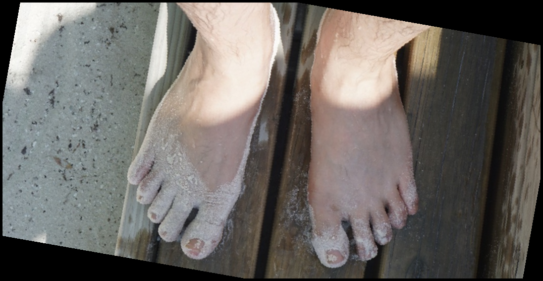 내성발톱 자가치료