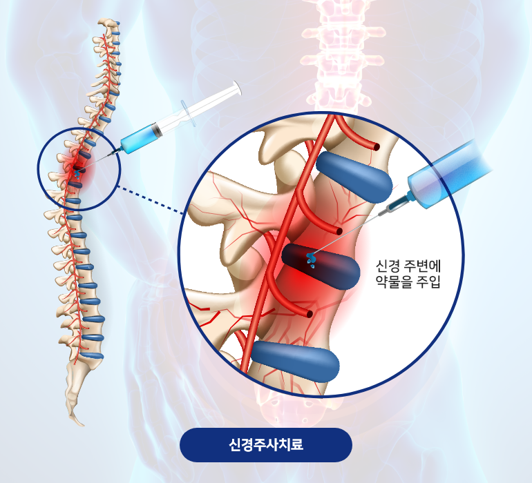 허리디스크 신경주사