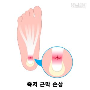 족저 근막염 증상