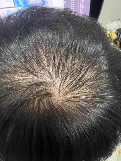 탈모-남자-정수리