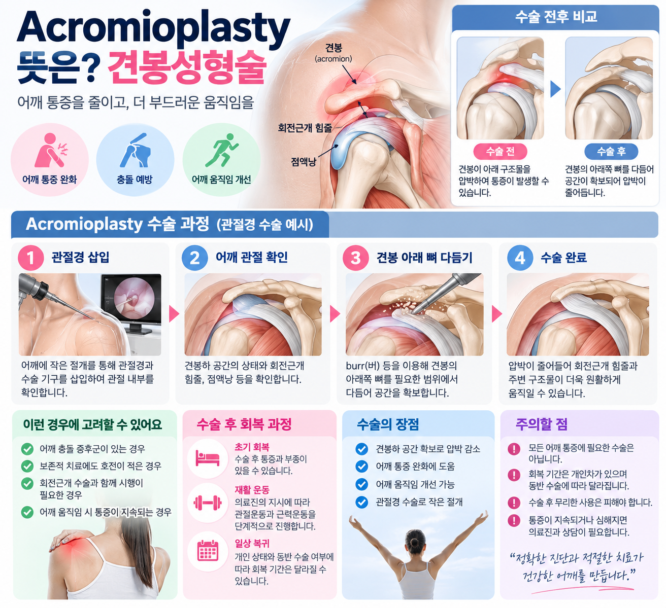 Acromioplasty 뜻은? 견봉성형술 수술 방법과 회복 과정