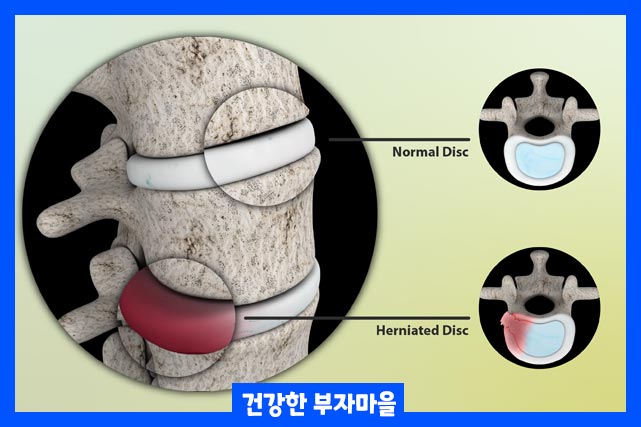항염증제, 근육 이완제를 사용하여 치료