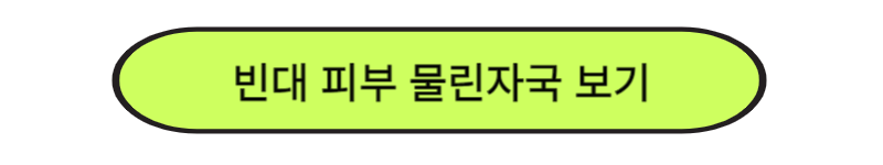 빈대 물린자국, 빈대 치료방법, 빈대 퇴치법 및 예방법