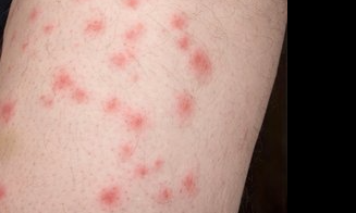 빈대인가요? 빈대 물린 자국, 약국 빈대 퇴치제 비오킬 써봐요