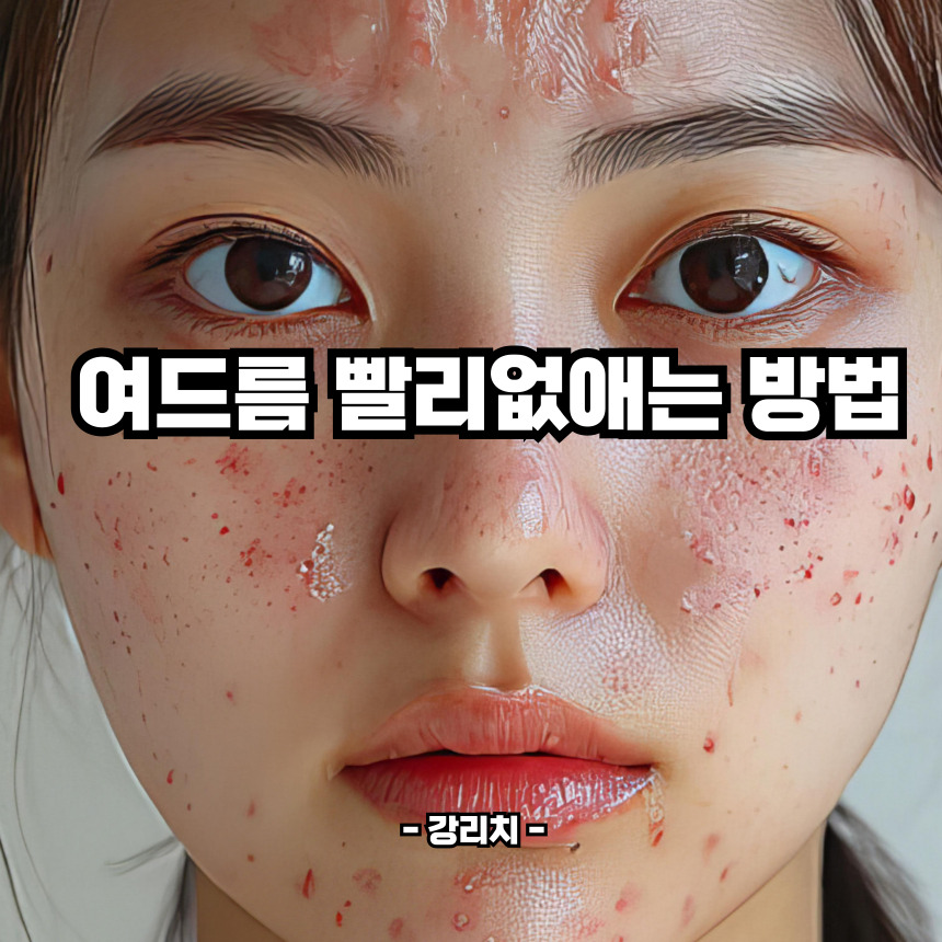 여드름 빨리없애는 방법