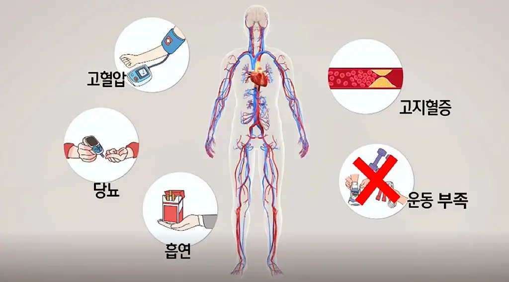 KBS 생로병사의 비밀 831회 뇌혈관, 심혈관, 말초혈관 두 곳 이상 동맥 경화 다혈관질환 주의할 점 오늘방송 다시보기 정보