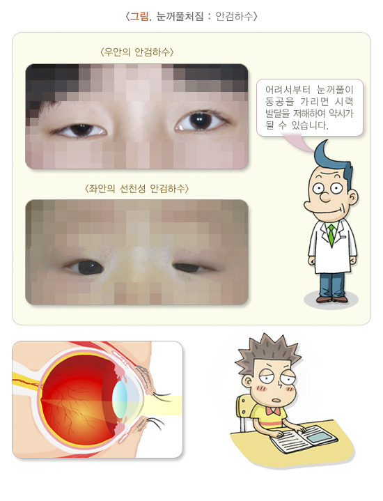쳐진 눈