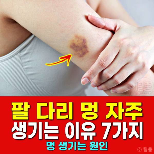 팔 다리 멍 자주 생기는 이유 멍원인