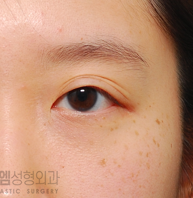 소세지눈 원인 3 라인이 높거나 두꺼운경우