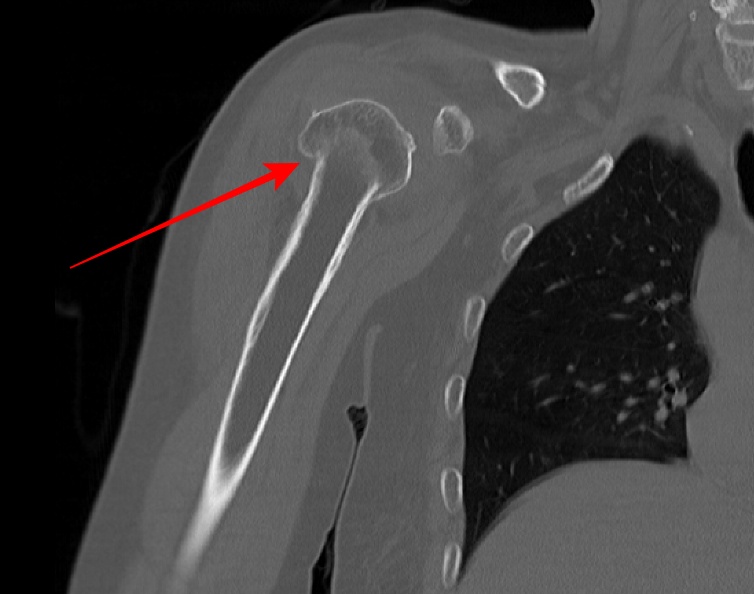 humerus cornal image