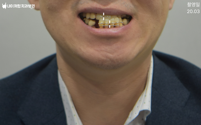 서울치과 이수역 내이처럼 전체 임플란트 전