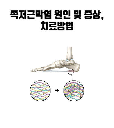 발뒤꿈치-아래-발바닥에-있는-섬유띠를-확대한-모습