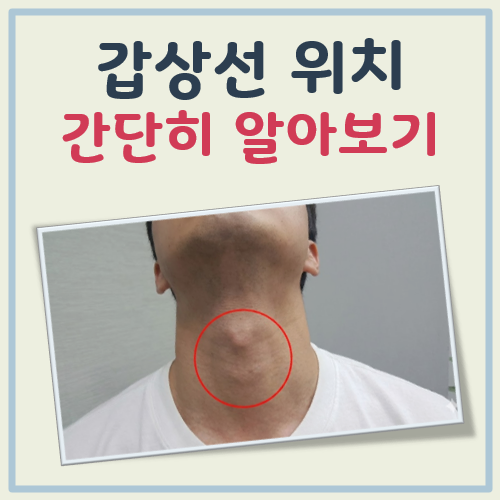갑상선 우위치 대표 이미지