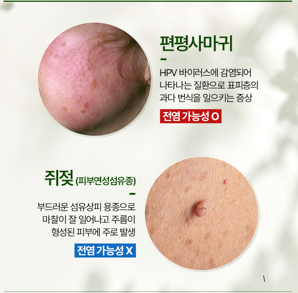 편평사마귀 원인&amp;#44; 증상&amp;#44; 치료 및 주의사항
