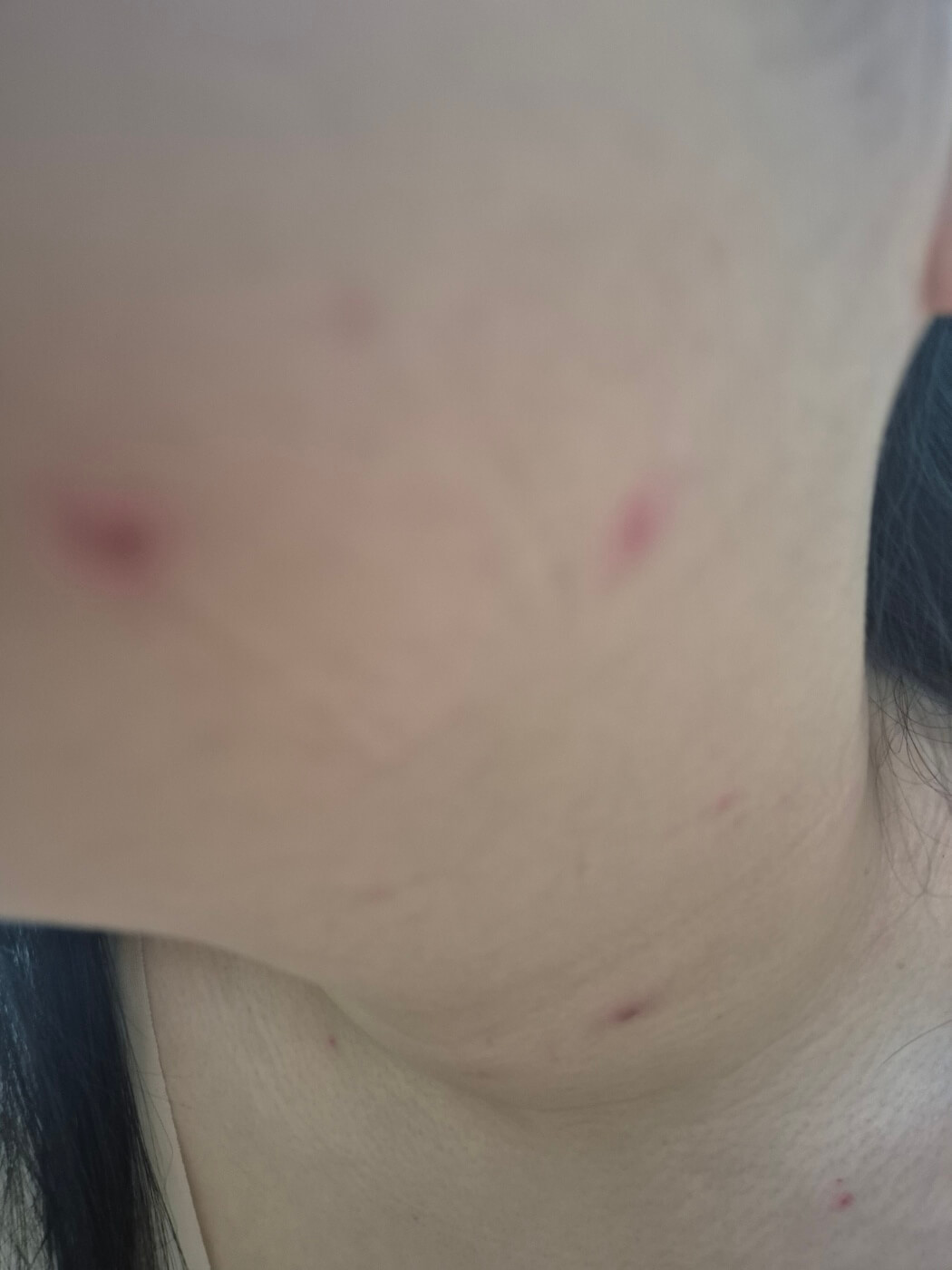 수두 증상 원인 격리 치료 및 예방방법 