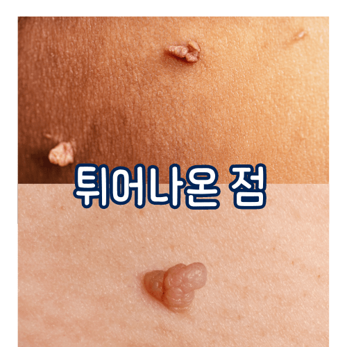 튀어나온-점-쥐젖-비립종-모반