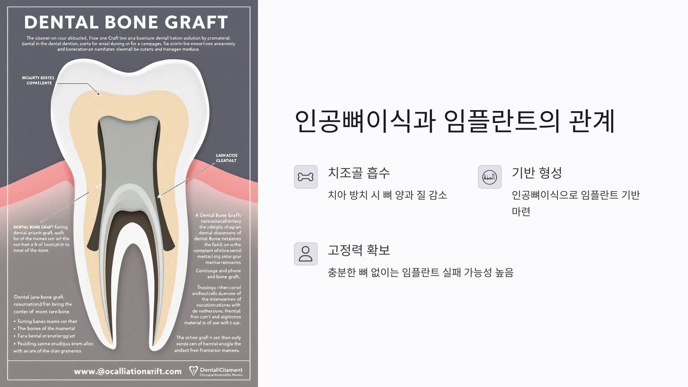 인공뼈이식과 임플란트의 관계는 어떤가요?