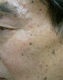 얼굴 검버섯 없애는 방법