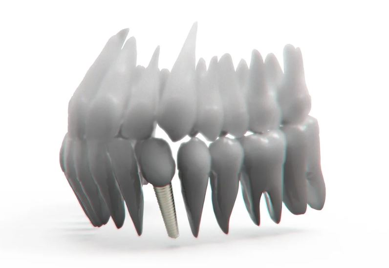 치아 임플란트