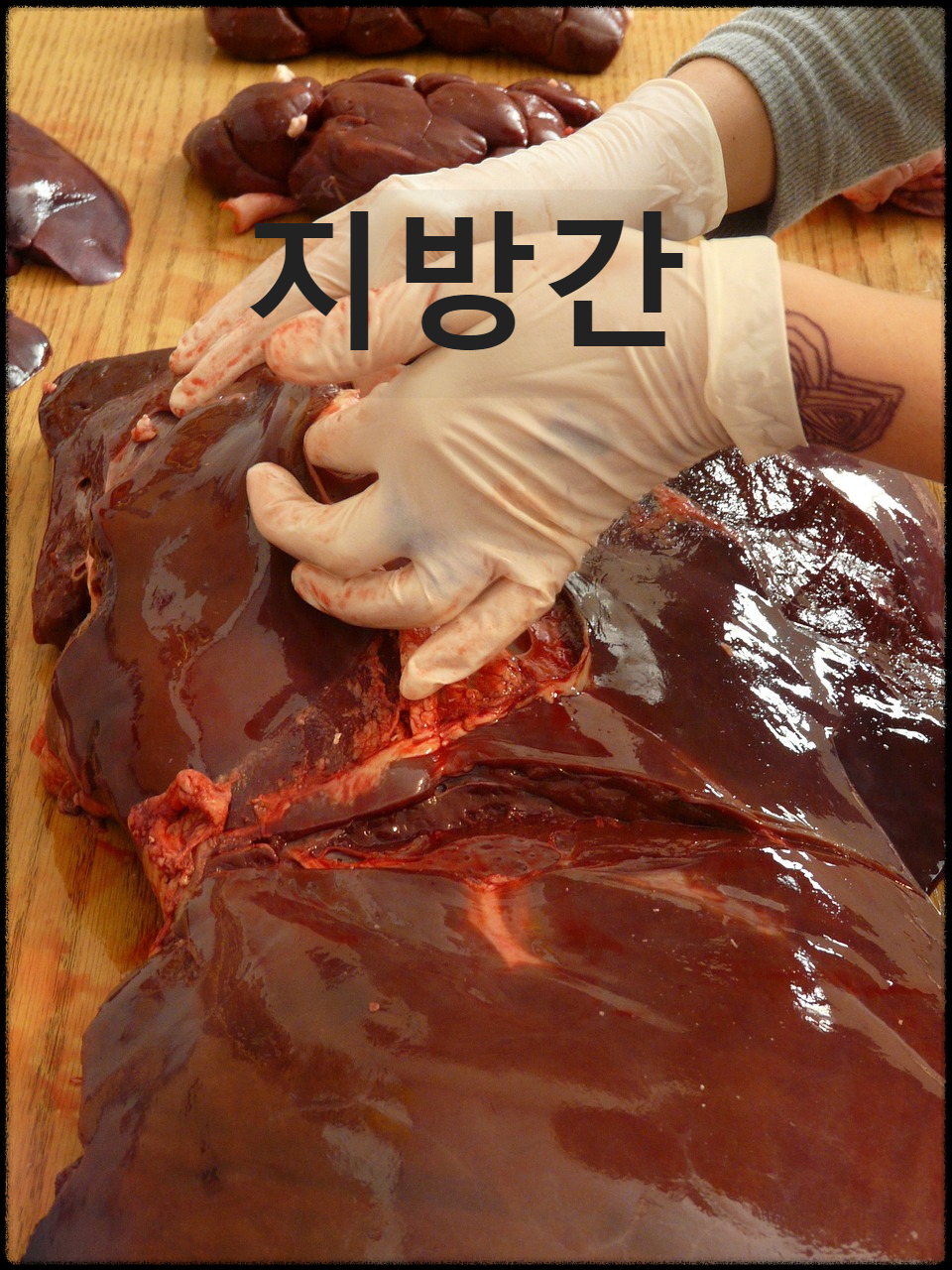 지방간