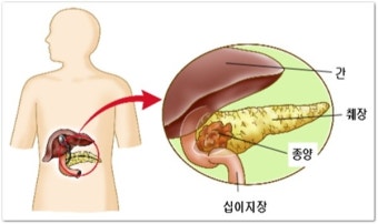 췌장암 초기증상과 진단 지연의 원인 &ndash; 왜 침묵의 암인가