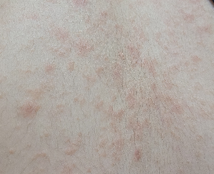 피부병 장미색 비강진