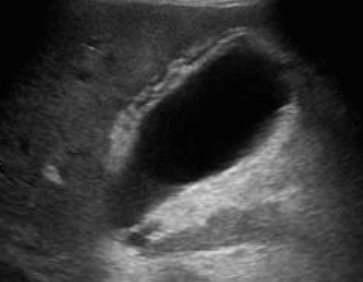 무결석 담낭염 (Acalculous cholecystitis )