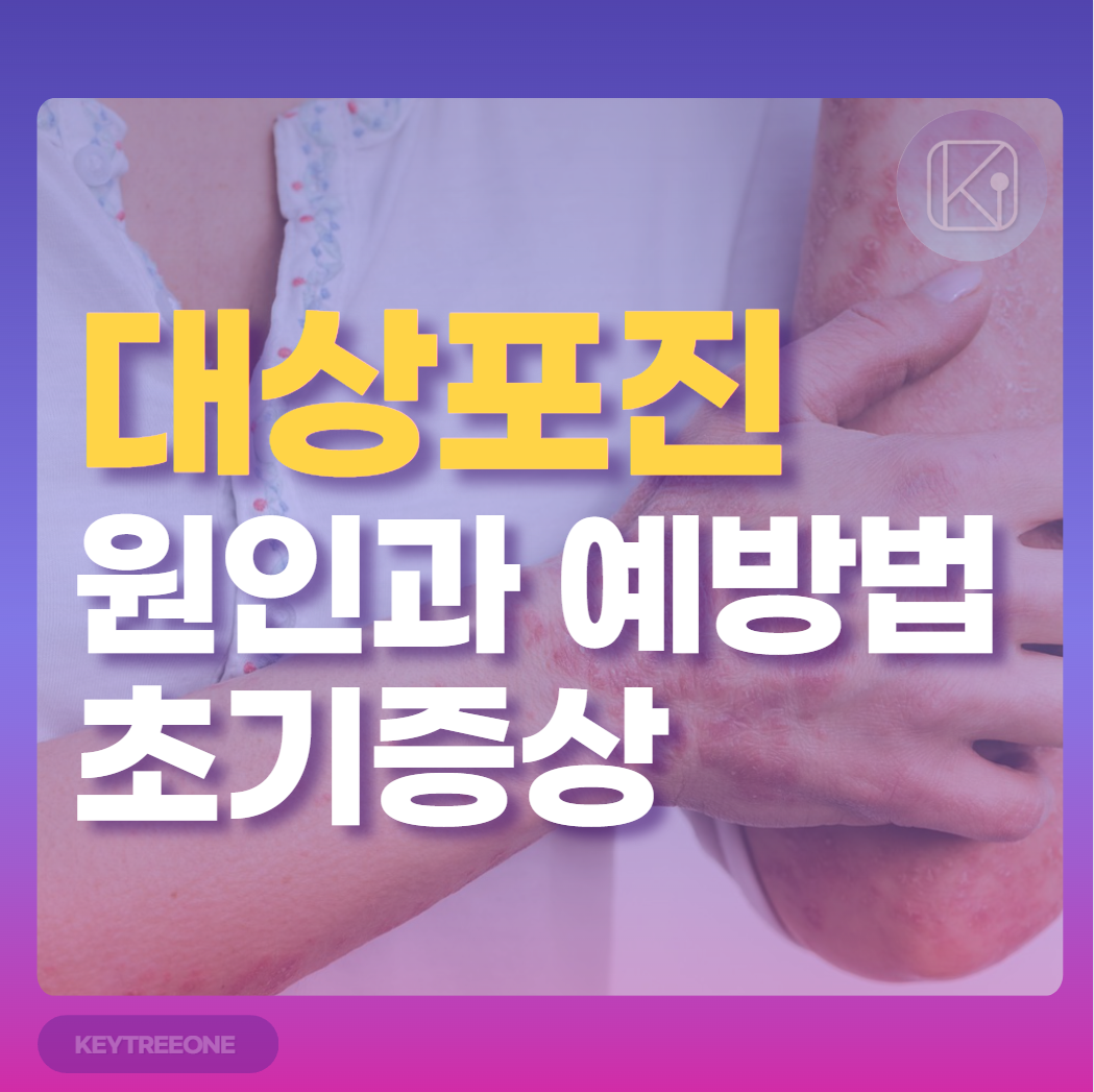 대상포진 원인과 예방법, 초기증상