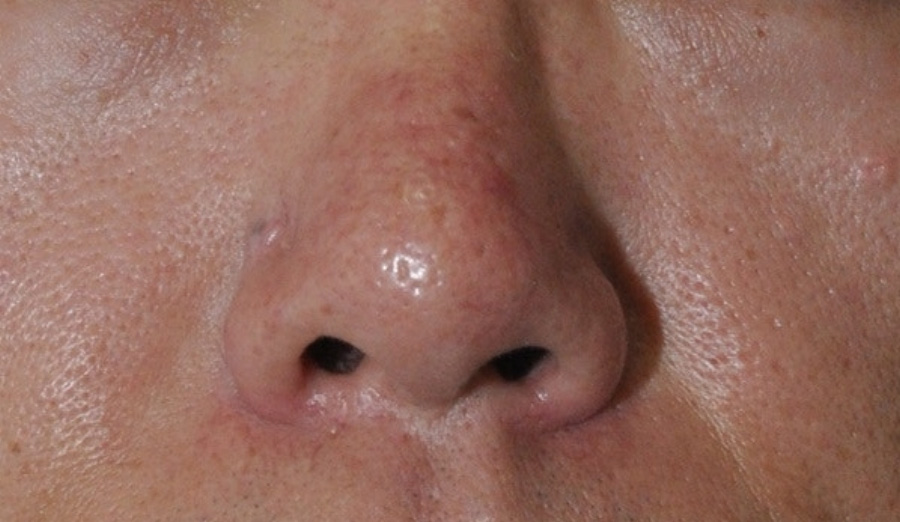코와 코의 옆 피부가 붉게 변하는 주사비 증상을 근접하여 확대를 하여 찍은 사진