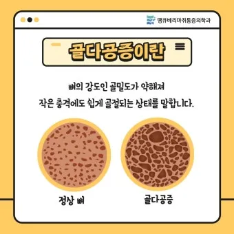 골밀도 검사 수치 골밀도 높이는 방법 간단 정리_15