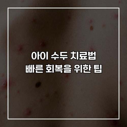 아이 수두 치료법, 빠른 회복을 위한 팁
