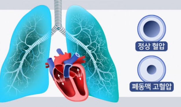 폐동맥고혈압 조기진단 생존율 폐동맥고혈압 폐고혈압증상 심장건강 호흡곤란 여성건강 난치병관리 심장내과 건강정보 심혈관질환
