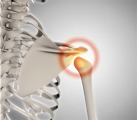 어깨충돌증후군수술