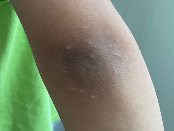 수족구 초기증상 사진 - 팔꿈치 부위 발진