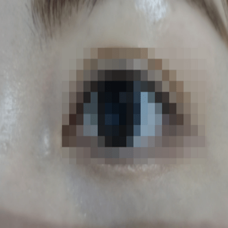 눈밑지방재배치 수술 후 사진 예시