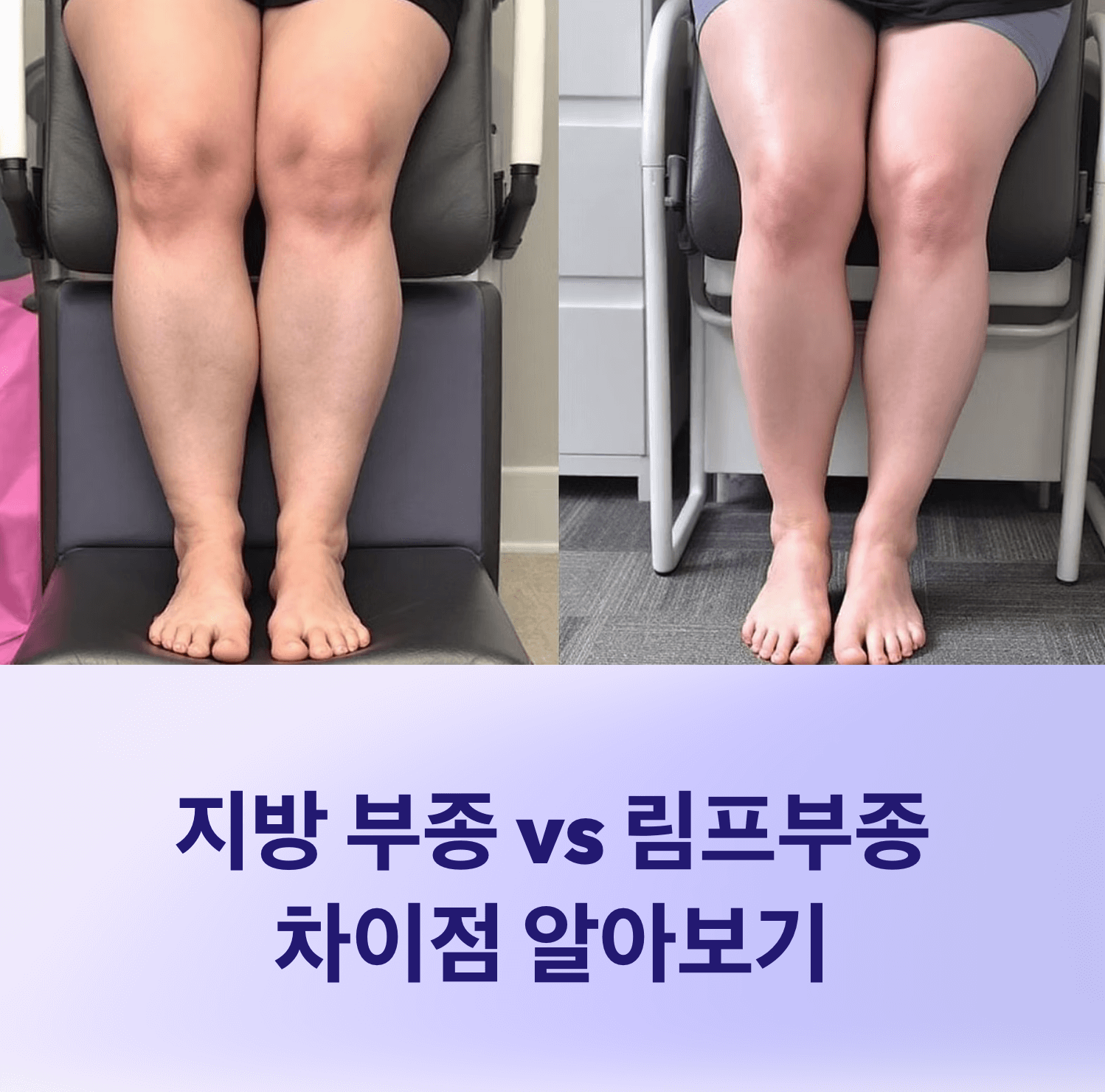 지방 부종과 림프부종 차이점 총정리