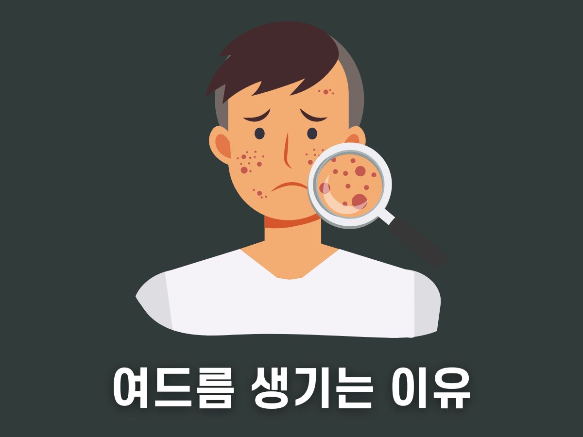 여드름 생기는 이유