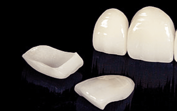 앞니에-자주-사용되는-올세라믹-크라운