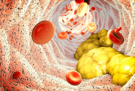 중성지방 낮추는 방법, 중성지방 정상수치