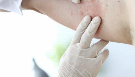 피부건조증 증상, 치료법, 좋은 음식과 연고 등 소개