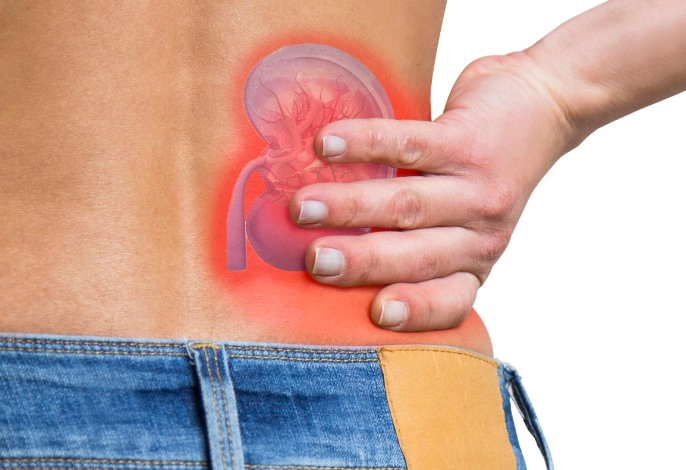 신장 결석 증상 4가지 및 신장 결석 파쇄기 체외충격파 쇄석술 비용 과정 총정리