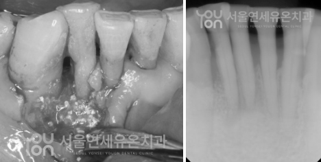 엠도게인을 이용한 치주재생수술 - 잇몸뼈 파괴 부위를 재생수술 하는 과정