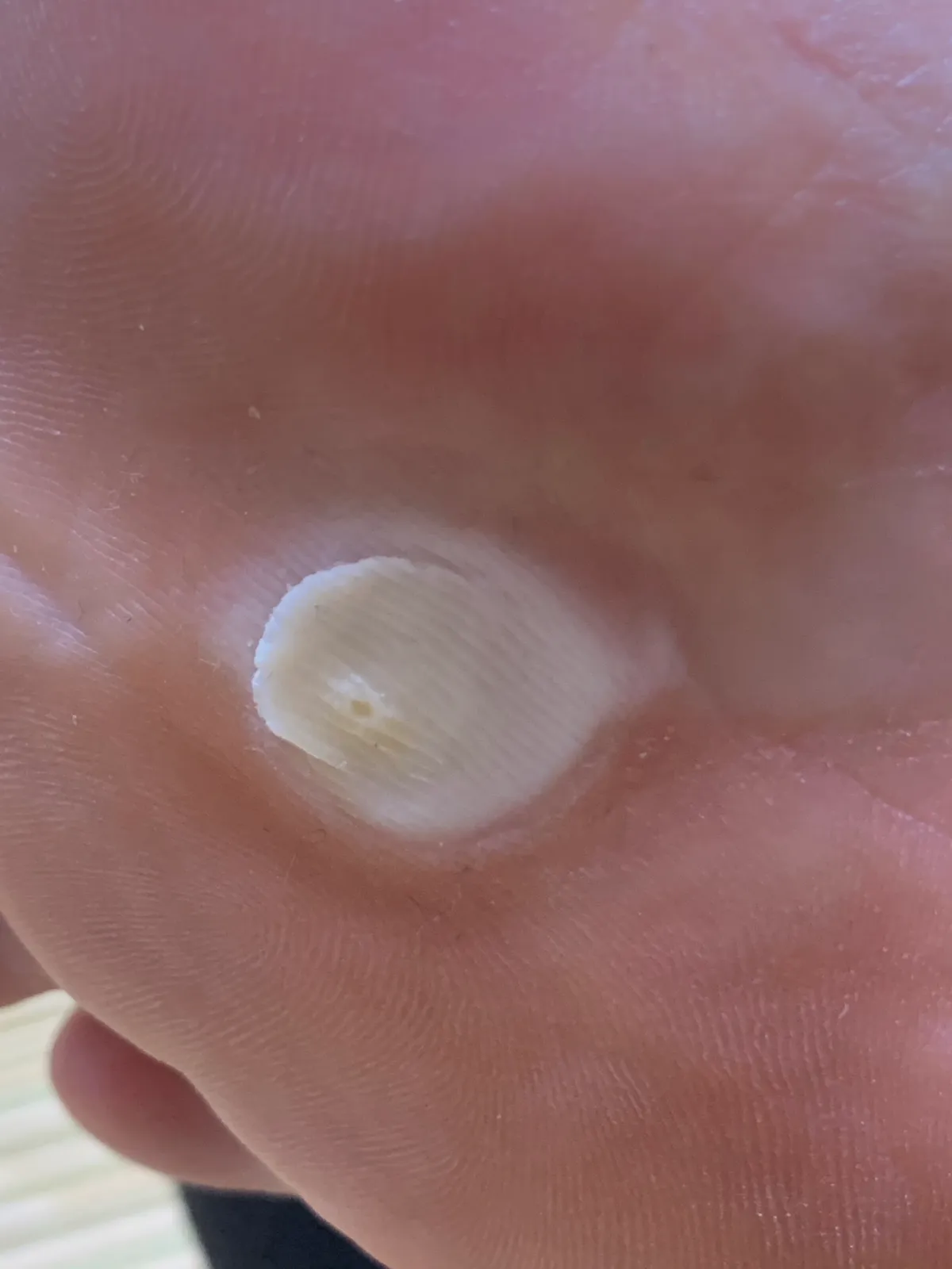 티눈밴드-사용후-굳은살